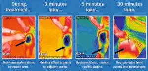 Cámara de crioterapia basada en nitrógeno líquido CryoStar | imagen_3