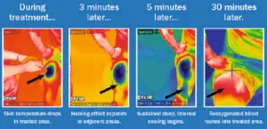 Captura de tela_5 - Câmaras de crioterapia e máquinas de emagrecimento VACUACTIVUS Câmara de crioterapia CryoStar baseada em nitrogênio líquido | imagem_3